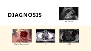 Urinary bladder exstrophy Presentation [Ayushi].pptx