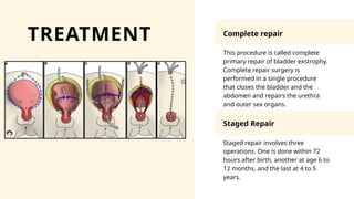 Urinary bladder exstrophy Presentation [Ayushi].pptx