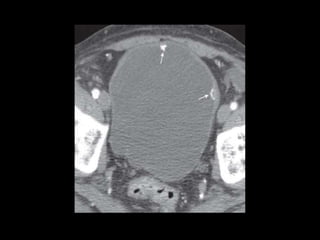 Urinary bladder pathologies | PPTX