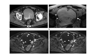 Urinary bladder pathology radiology | PPTX