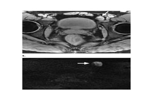 Urinary bladder pathology radiology | PPTX