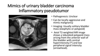Mimics of urinary bladder carcinoma
Inflammatory pseudotumor
• Pathogenesis: Unclear
• Can be locally aggressive and
mimic malignancy
• Imaging: Usually solitary bladder
mass (exophytic or polypoid)
• Axial T2-weighted MR image
shows a lobulated polypoid mass
arising from the anterior wall of
the bladder with central
hyperintensity (*) and low
peripheral signal intensity
(arrowhead).
 