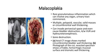 Malacoplakia
• Rare granulomatous inflammation which
can involve any organ, urinary tract
commonest.
• Multiple, polypoid, vascular, solid masses
or circumferential wall thickening.
• Can invade perivesical space and even
cause bladder obstruction, A/w VUR and
hydroureteronephrosis.
• bone destruction.
• (a) Axial CT image shows marked
circumferential bladder wall thickening. (b)
Photograph of the cut, resected specimen
shows a friable, hemorrhagic mucosal
surface and dramatic wall thickening.
 