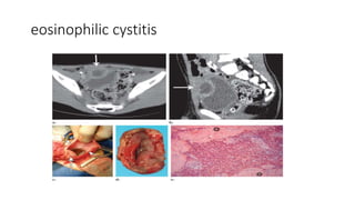 eosinophilic cystitis
 