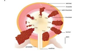 Urinary bladder pathology radiology | PPTX
