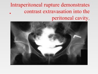 Intraperitoneal rupture demonstrates
contrast extravasation into the
peritoneal cavity.
•
 