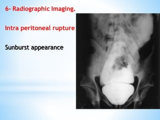 6- Radiographic Imaging.
Intra peritoneal rupture
Sunburst appearance
 