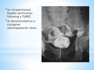 *An intraperitoneal
bladder perforation
following a TURBT,
*As demonstrated on a
cystogram
(anteroposterior view).
 