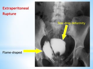 Extraperitoneal
Rupture
Flame-shaped
Tear drop deformity
 