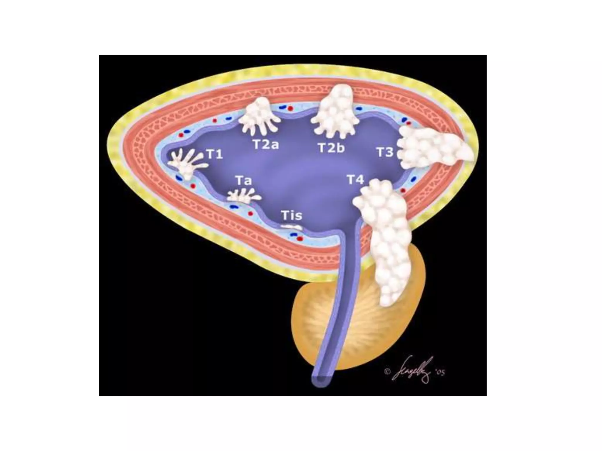 Urinary Bladder Tumor Ppsx