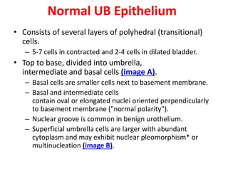 Urinary bladder tumor | PPSX