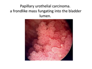 Papillary urothelial carcinoma.
a frondlike mass fungating into the bladder
lumen.
 