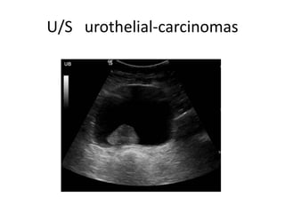 U/S urothelial-carcinomas
 