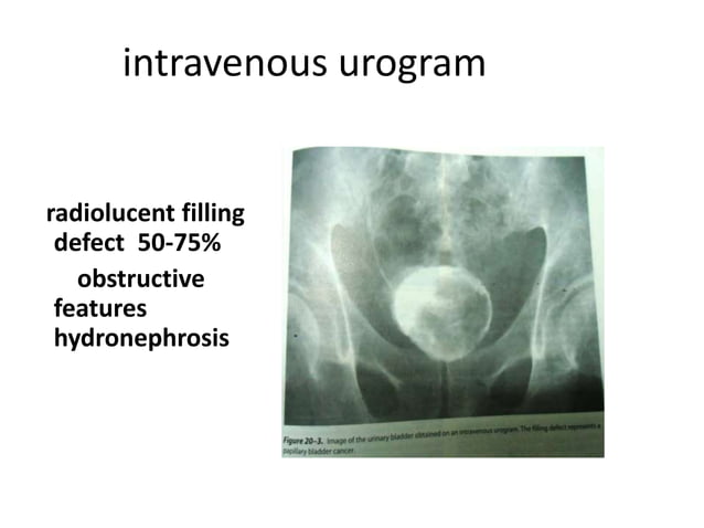 Urinary Bladder Tumor Ppt