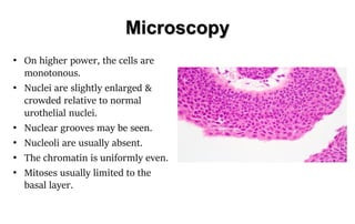 URINARY BLADDER TUMORS.pdf