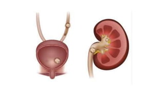 Urinary Calculi.pptx