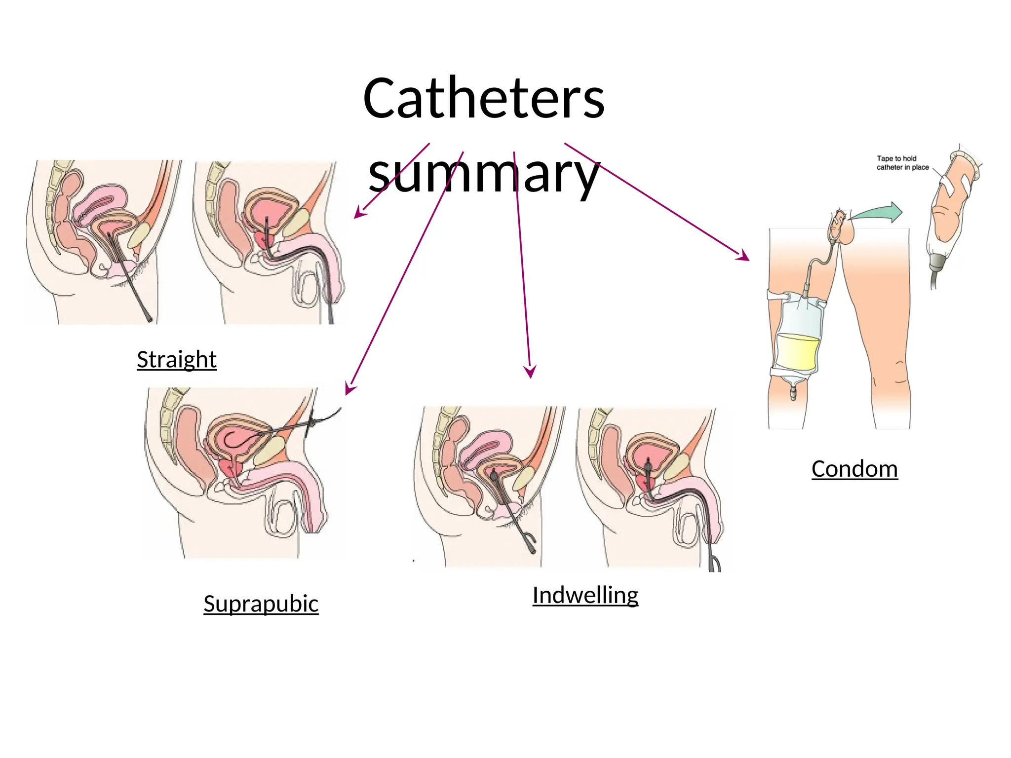 urinary-catheterazation-medical-and-surgicalppt-ppt