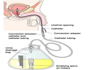 URINARY CATHETERAZATION Medical and surgicalppt PPT