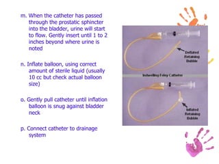 m. When the catheter has passed
through the prostatic sphincter
into the bladder, urine will start
to flow. Gently insert until 1 to 2
inches beyond where urine is
noted
n. Inflate balloon, using correct
amount of sterile liquid (usually
10 cc but check actual balloon
size)
o. Gently pull catheter until inflation
balloon is snug against bladder
neck
p. Connect catheter to drainage
system
 