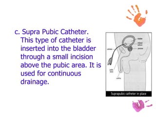 c. Supra Pubic Catheter.
This type of catheter is
inserted into the bladder
through a small incision
above the pubic area. It is
used for continuous
drainage.
 