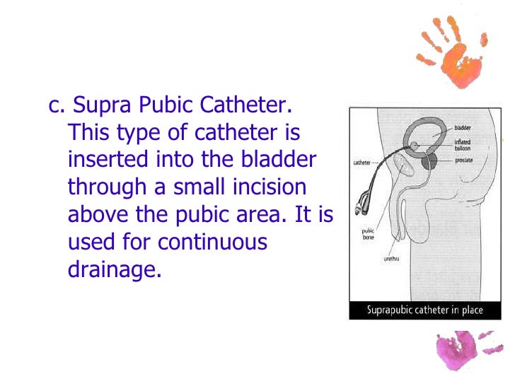 Urinary Catheterization