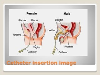 Catheter insertion image
 