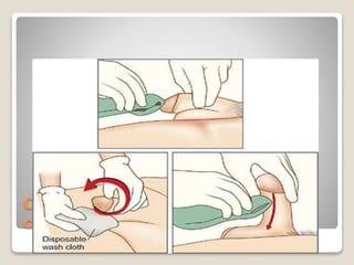 Cleaning before the
catheterization
 