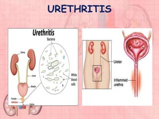 URETHRITIS
 
