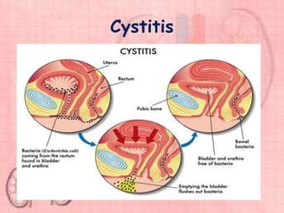 Cystitis
 