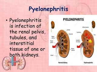 Pyelonephritis
• Pyelonephritis
is infection of
the renal pelvis,
tubules, and
interstitial
tissue of one or
both kidneys.
 