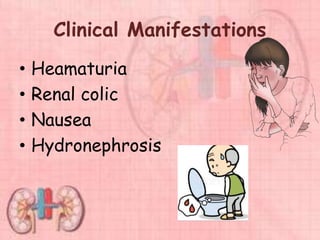 Clinical Manifestations
• Heamaturia
• Renal colic
• Nausea
• Hydronephrosis
 