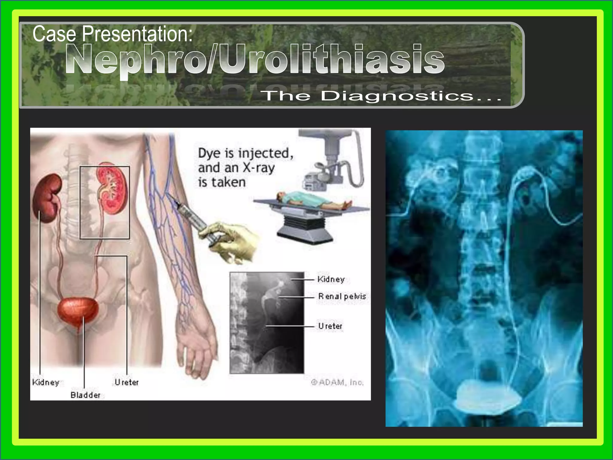 Case Presentation:Nephro/UrolithiasisNephro/UrolithiasisDetermining EtiologyKey points:Key points:Gout