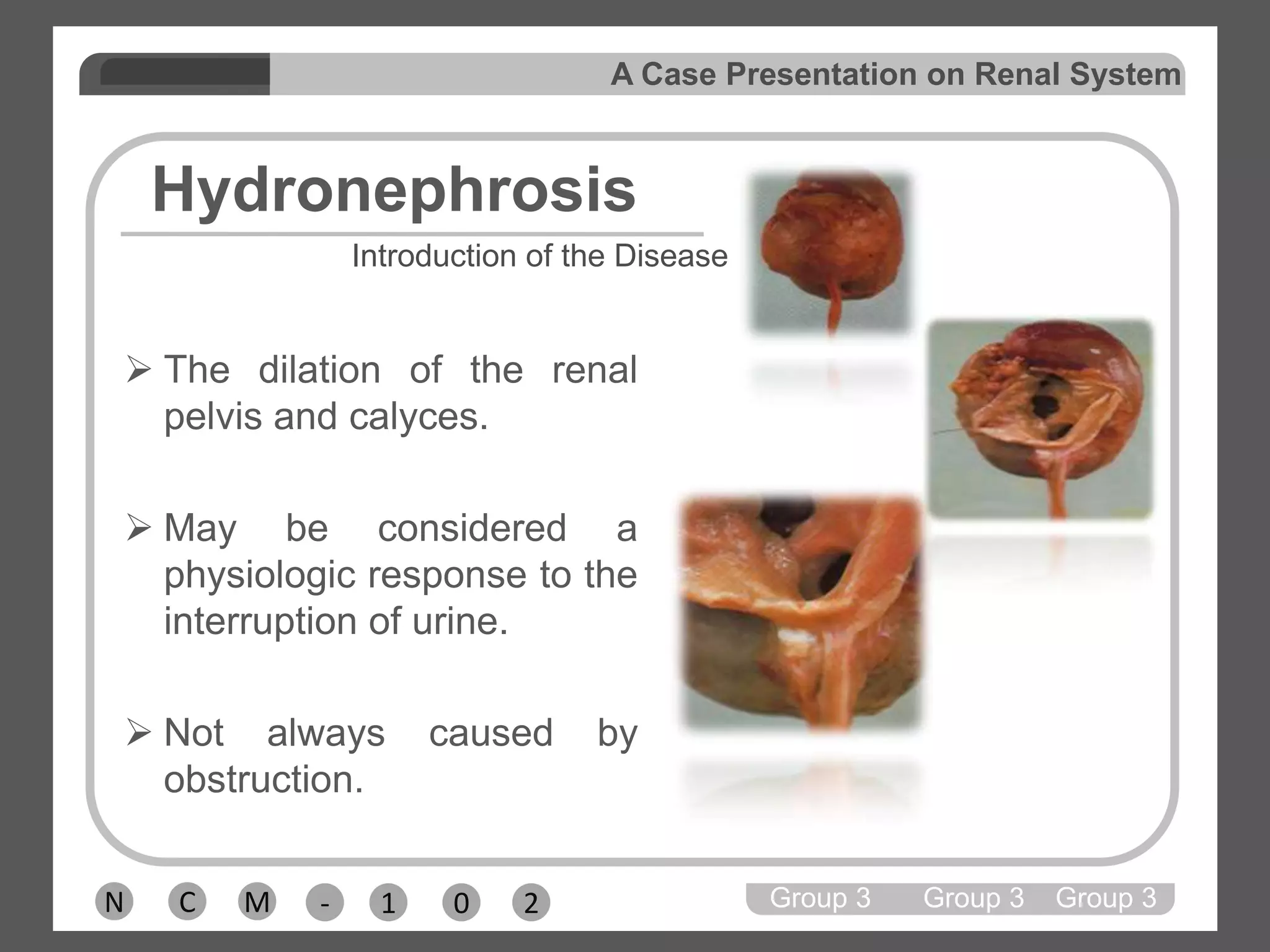 Conditions associated with an increased risk of kidney stones include hyperparathyroidism, kidney diseases such as renal tubular acidosis, and some inherited metabolic conditions including cystinuria and hyperoxaluria. Chronic diseases such as diabetes and HPN are also assoc. with an increased risk of developing kidney stones.