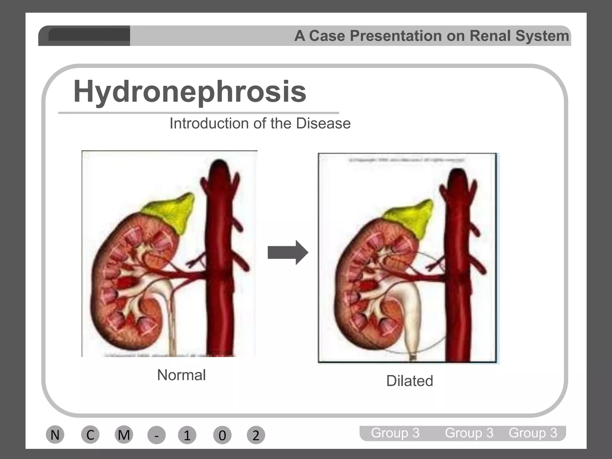 Hyperparathyroidism