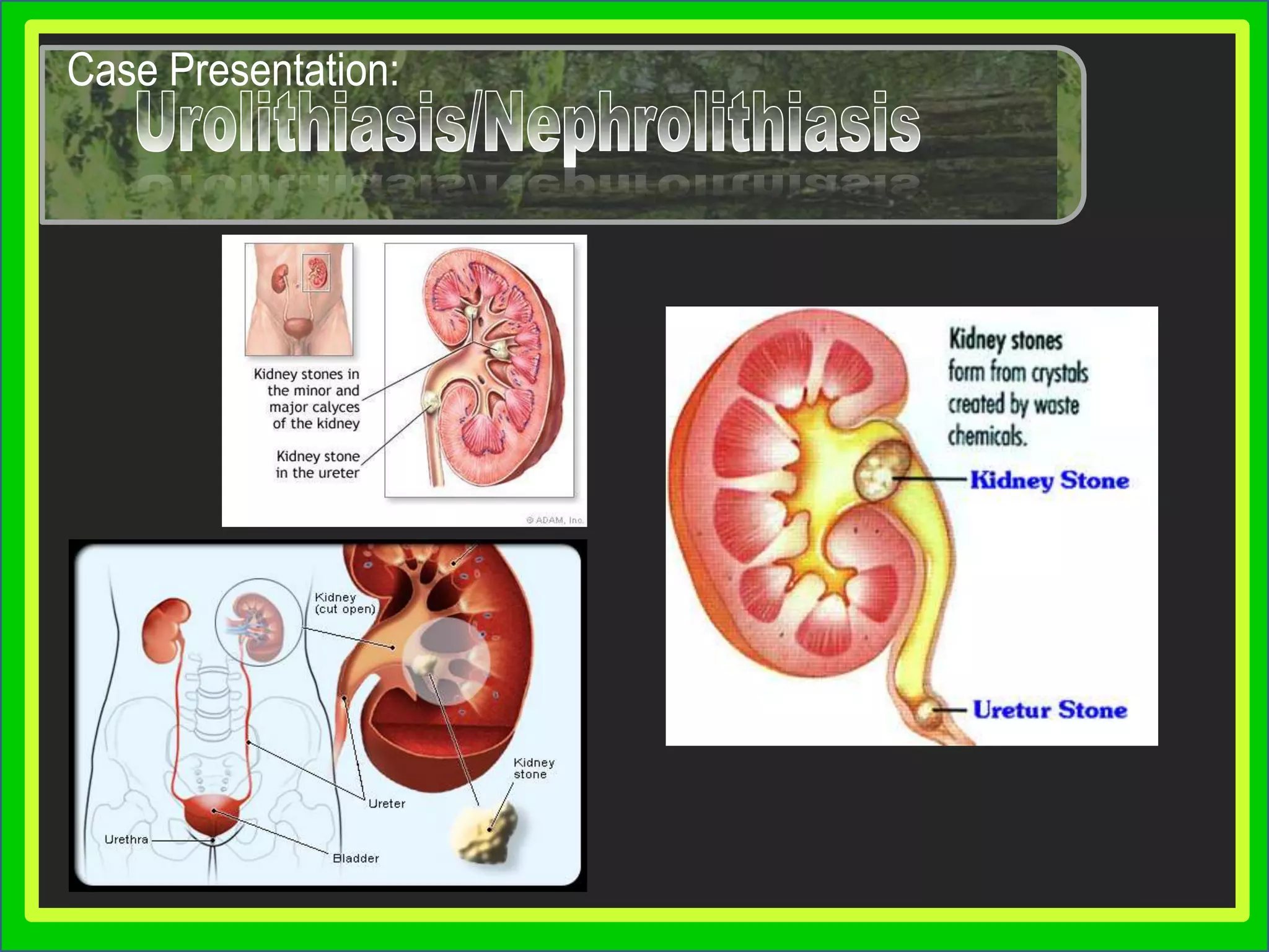 13% in men and 7% in women, increasing in industrialized worldFeed Your Mind…Presentation SkillsCase Presentation:UrolithiasisUrolithiasisIntroduction of the Diseaseis the condition where urinary calculi are formed in any part of the urinary tract.