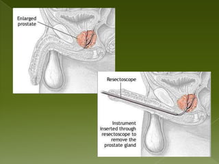 May exhibit:Enlarged, tender prostate TEACHING/LEARNING May report: Family history of cancer, hypertension, kidney disease 
