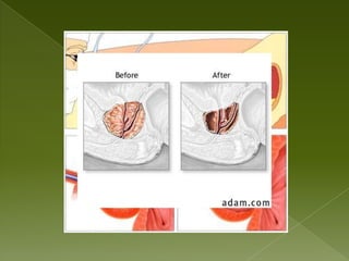 Use of antihypertensive or antidepressant medications, OTC cold/allergy medications containing sympathomimetics, urinary antibiotics or antibacterial agents 