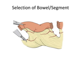 Selection of Bowel/Segment 
 