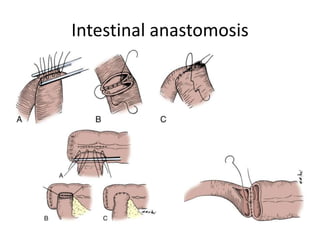 Intestinal anastomosis 
 