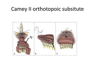 Camey II orthotopoic subsitute 
 