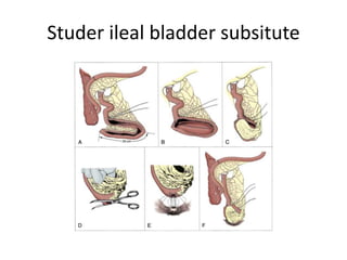 Studer ileal bladder subsitute 
 