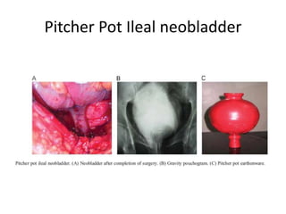 Pitcher Pot Ileal neobladder 

