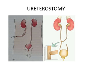 URETEROSTOMY
 