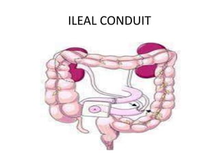 ILEAL CONDUIT
 