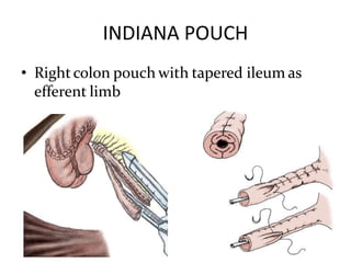 INDIANA POUCH
• Rightcolon pouch with tapered ileum as
efferent limb
 