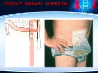 CONDUIT URINARY DIVERSION
 