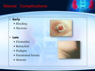 Stomal Complications
 