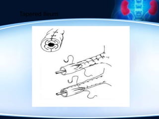 Tapered Ileum
 