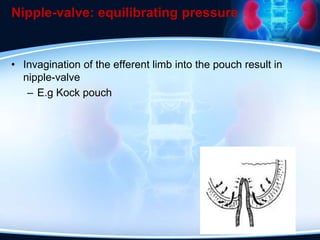 Nipple-valve: equilibrating pressure
• Invagination of the efferent limb into the pouch result in
nipple-valve
– E.g Kock pouch
 
