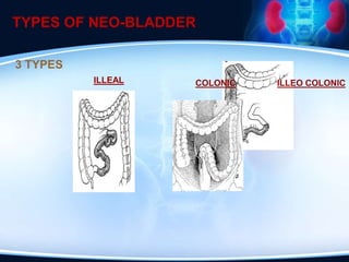 TYPES OF NEO-BLADDER
ILLEAL ILLEO COLONIC
COLONIC
3 TYPES
 